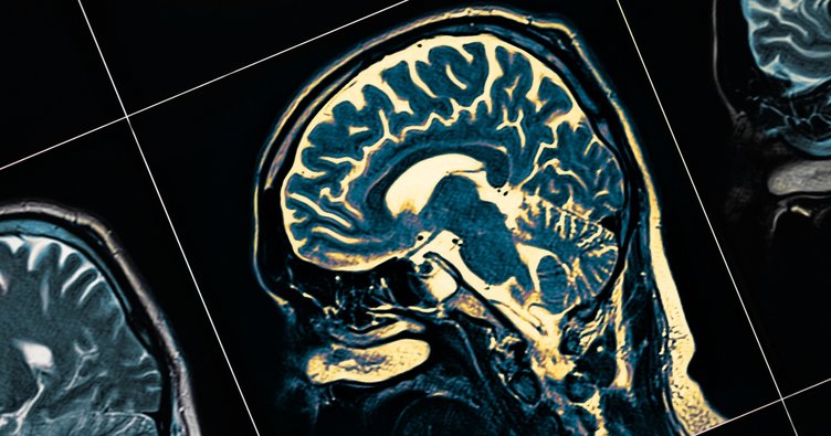 Kanada’da Bilinmeyen Yeni Bir Beyin Hastalığı Ortaya Çıktı!