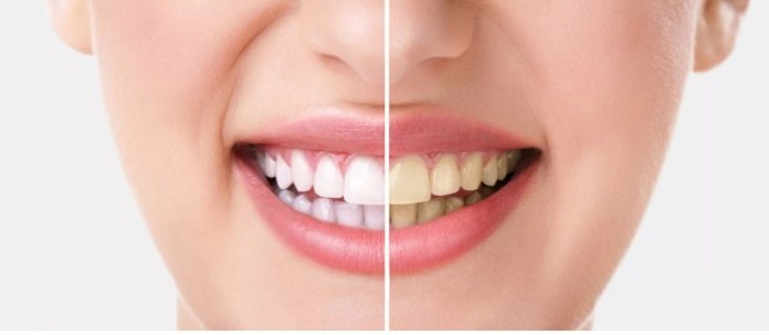 Diş beyazlaştırma yöntemi “ağartma”, mutlaka doktor kontrolünde uygulanmalı