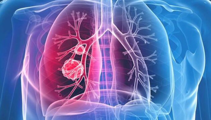 Akciğer damarlarına pıhtı atması, ani ölümlere neden olabilir